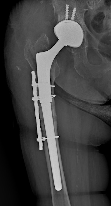 LIMA Delta Total Hip Prosthesis (Implant 2205272)